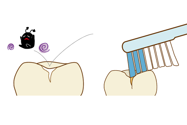 シーラントで虫歯を防ぐイラスト